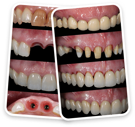 Evoluzione in Protesi Fissa